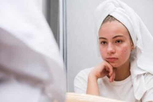Effets psychologiques de l'acné juvénile