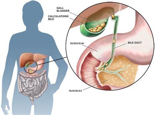 Nutrición para cálculos biliares: que comer y que evitar