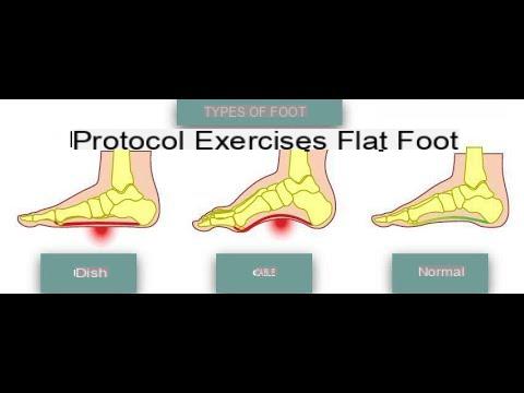 Exercices pour pieds plats