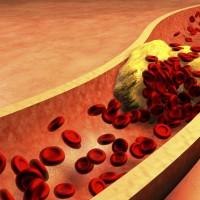 Hypercholestérolémie : les aliments à éviter