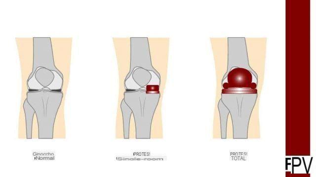 Knee prosthesis - Recovery after surgery, Risks and Benefits
