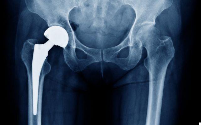 Hip prosthesis - Course and Risks of the Surgery